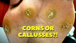 THICK DEEP Seeded Corn and Callus Removal [upl. by Yahska]