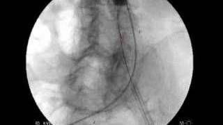 Endovascular Aneurysm Repair For AAA [upl. by Hassi]