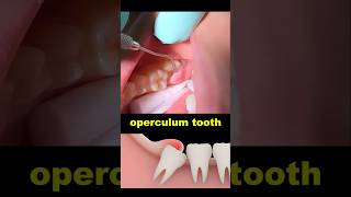 Operculum tooth treatment dentist dentistry wisdomtooth [upl. by Pall394]