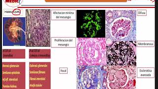 Qx reumatologia  LUPUS ERITEMATOSO SISTEMICO [upl. by Lorry]