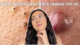 How To Treat Every Type of Acne Comedones Nodules Cysts [upl. by Einomrah]