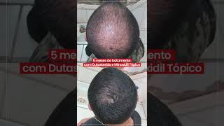 ANTES E DEPOIS  DUTASTERIDA E MINOXIDIL TÓPICO [upl. by Enitsuj]