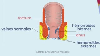 Santé  Tout sur les hémorroïdes [upl. by Caro]