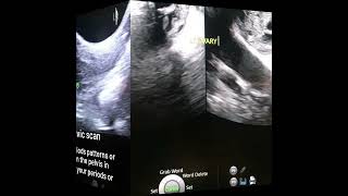 Pelvic Ultrasound Scan [upl. by Grega679]