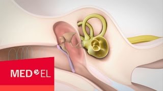 Mixed Hearing Loss Sensorineural and Conductive Hearing Loss  MEDEL [upl. by Eeralav]