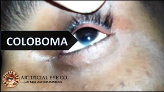 Coloboma Iris and Nystagmus  Anophthalmia  Dr Sumitra [upl. by Epifano]