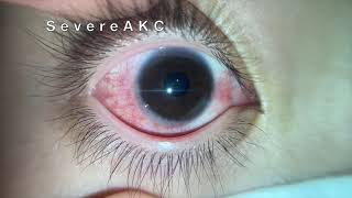 Severe AKC Atopic keratoconjunctivitis [upl. by Jain]