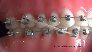 Les élastiques de Classe 3 en technique orthodontique vestibulaire [upl. by Huberty389]