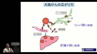 大腸がん〜大腸がんの外科的な治療と薬物療法〜志田 大・吉野 孝之 [upl. by Notluf259]