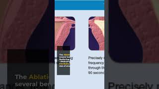 Painless Pulmonary Vein Isolation Your Ultimate Guide to Atrial Fibrillation Ablation [upl. by Aiahc]