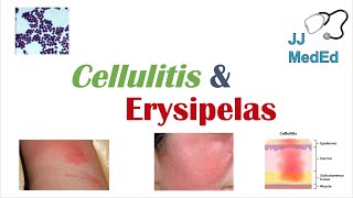 Cellulitis vs Erysipelas  Bacterial Causes Risk Factors Signs and Symptoms Treatment [upl. by Jari]