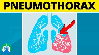 Pneumothorax Medical Definition  Quick Explainer Video [upl. by Kirre]