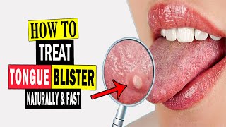 How to Treat Tongue Blisters Naturally  Home Remedies for Tongue Blisters Treatment [upl. by Kancler]