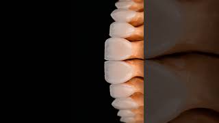 smilemore dentalphotograpy uae ksa el kuwaitcity abudhabi picassodentallab shine veneers [upl. by Essy]