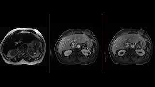 Calyceal diverticulum [upl. by Ientruoc]