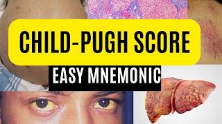 ChildPugh Score  Easy Mnemonic [upl. by Alyam]