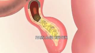 Appendicitis  Meditoons™ [upl. by Nielsen]