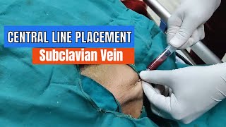 Central Line placement Subclavian Vein Approach [upl. by Pearlman]