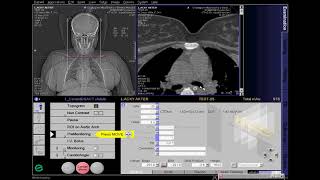 CT Carotid Angio Full Work Process SIEMENS in syngo acquisition workplace [upl. by Nivan]