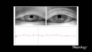 Alternating horizontal single saccadic pulses in progressive supranuclear palsy [upl. by Aryas372]