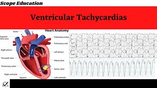 Identifying the Different Types of Ventricular Tachycardias [upl. by Simson]