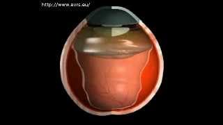 Vitreous base relaxation  Scleral Bucklingfor Retinal Detachement [upl. by Gilford]