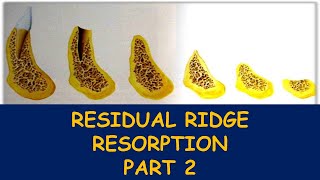 Pathogenesis of Residual ridge resorptionpart 2 lecture seriesepisode 12 [upl. by Kitarp]