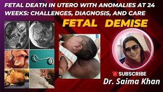 Fetal Death in Utero with Anomalies at 24 Weeks Challenges Diagnosis and Care drsaima khan case [upl. by Syned713]