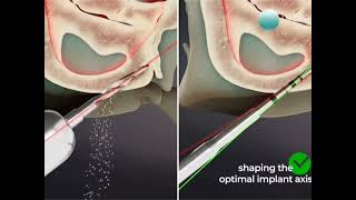 Use of osteotome Angulation of osteotomy in engaging pterygoid implants Animated demo [upl. by Llednek787]