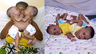 Watching Our Conjoined twins Take Their Last Breath  THIS VIDEO WILL MAKE YOU CRY [upl. by Lahcym]