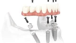 Dental Implant Osseointegration Process [upl. by Ailimaj]