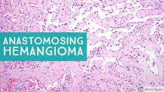 Anastomosing Hemangioma 101Explained by a Soft Tissue Pathologist [upl. by Politi]