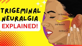 Trigeminal Neuralgia  Explained  Worlds most painful disease Causes and Treatment [upl. by Nisotawulo589]