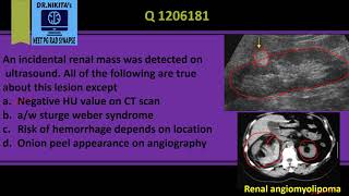 Renal angiomyolipoma Classical radiological features [upl. by Drice]