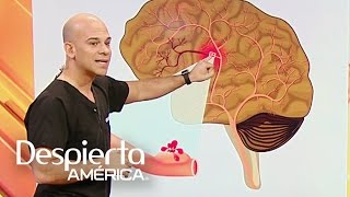 ¿Cómo detectar las señales de un aneurisma cerebral [upl. by Sikko]