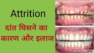 Attrition of teeth causes and treatmentदांत घिसने के कारण और इलाजgrinding and bruxism treatment [upl. by Mulligan]