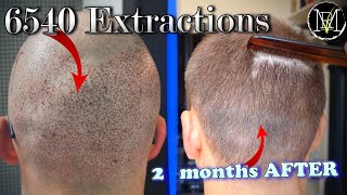 Haircut 2 months after Hair Transplant Donor Area  NW5a  6500 grafts [upl. by Naesal]