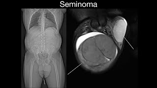 Seminoma [upl. by Gallagher]