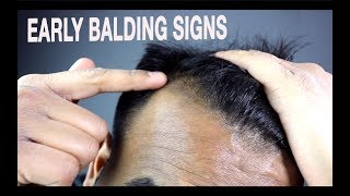 How To Know if Youre Going Bald  Signs of Male Pattern Baldness [upl. by Sibeal391]