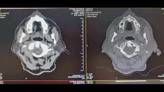 Fungal Sinusitis  Nasal Sinus Mycetoma Surgery [upl. by Ahsenyl]