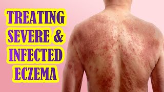 How To Manage Infected and Severe Eczema  Treatment Options [upl. by Eecyac]