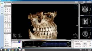 How to Segment the Maxillary Sinus in LED Dentals Xelis 3D Imaging Software [upl. by Ennaeerb169]