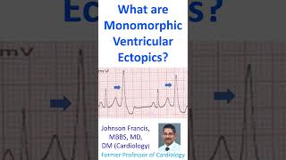 What are monomorphic ventricular ectopics [upl. by Ordnaxela]