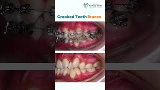 Crooked Teeth Braces shorts dentist braces [upl. by Hausmann]