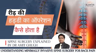 रीढ़ की हड्डी का ऑपरेशन कैसे होता है Understanding Minimally Invasive Spine Surgery  Dr Amit Chugh [upl. by Nirak689]