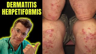 Dermatitis Herpetiformis rash seen in Coeliac Disease aka gluten intolerance explained [upl. by Kyne]