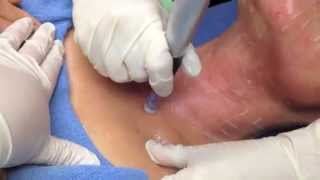 Dermapen video explaining procedure and showing procedure done [upl. by Euginom]