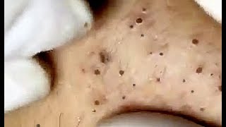 Amazing Blackheads just wait for it [upl. by Bunker]