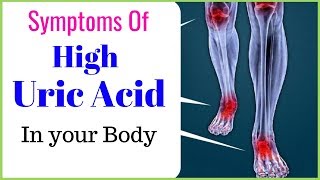 Signs and symptoms of high uric acid level in a body [upl. by Oliva86]