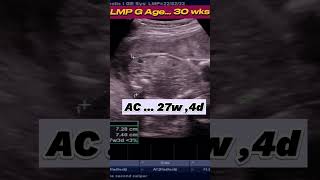 High Risk BABY  30wks Pregnancy IUGR ultrasound pregnancy baby [upl. by Ollopa]